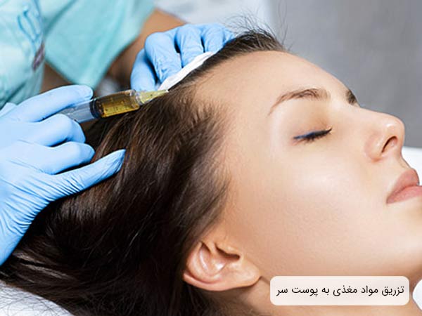 تزريق محتويات مزو مو به سر يک خانم توسط متخصص.