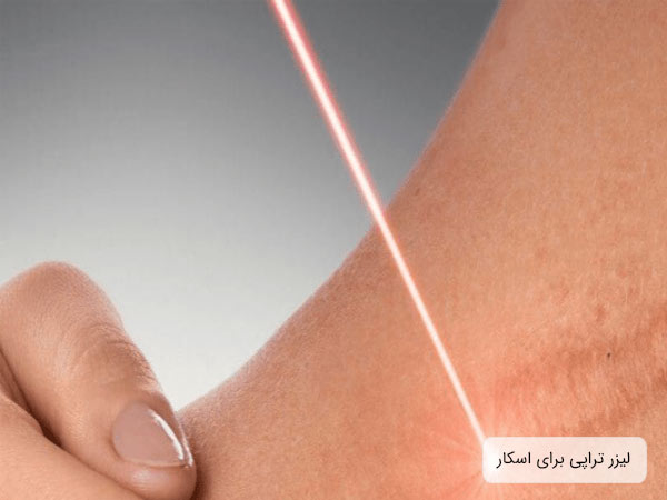 اشعه ليزر روی يک اسکار پوستی.