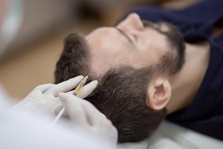 انجام مزوتراپی مو روی سر يک آقا توسط پزشک.