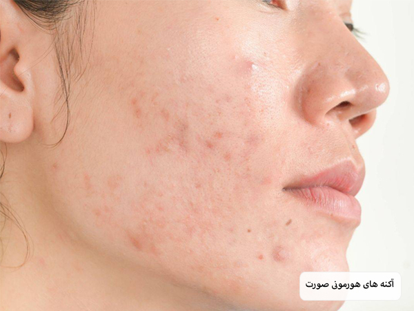 آکنه های هورمونی روی صورت یک خانم در پس زمینه سفید.