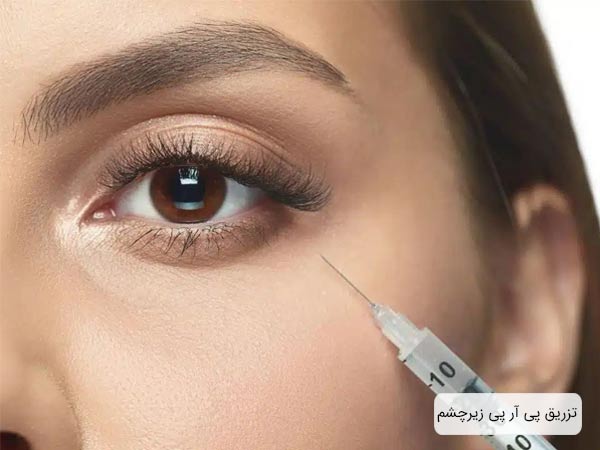 تزريق پی آر پی به زير چشم يک خانم.