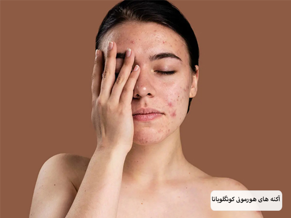 آکنه کونگلوبانا روی صورت یک خانم.