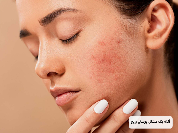 آکنه پوستی روی صورت یک خانم جوان با پس زمینه کرمی رنگ.