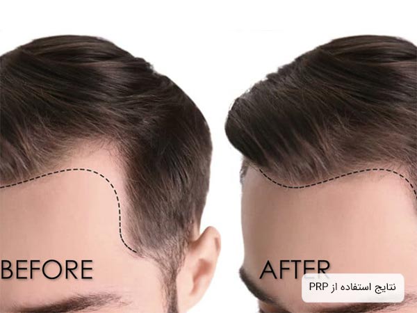 افزايش مو هاي سر يک آقا بعد از تزريق پی آر پی.