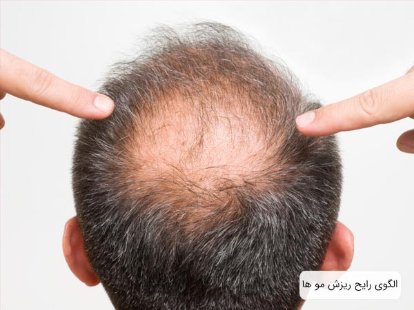 مو های سر يک آقا که از وسط ريزش نموده است و دستانی که دارند به الگوی طاسی ذکر شده اشاره ميکنند در پس زمينه سفيد.