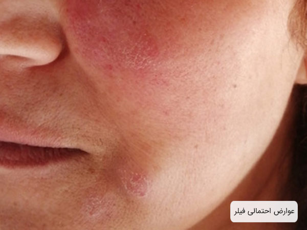سرخ شدن صورت يک خانم در اثر تزريق فيلر پوستي.