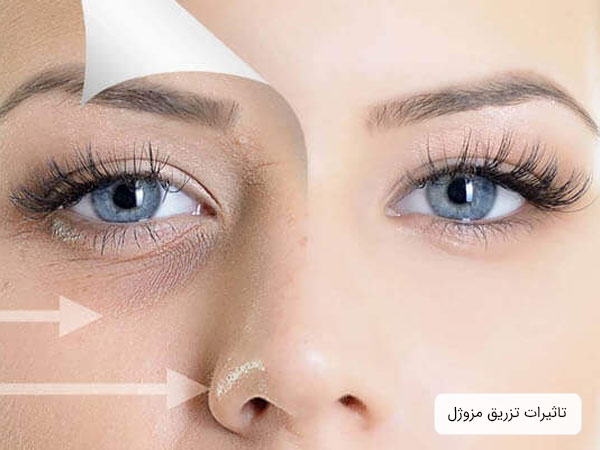 صورت يک خانم قبل و بعد از تزريق مزوژل که دچار بهبود قابل توجهي شده است.