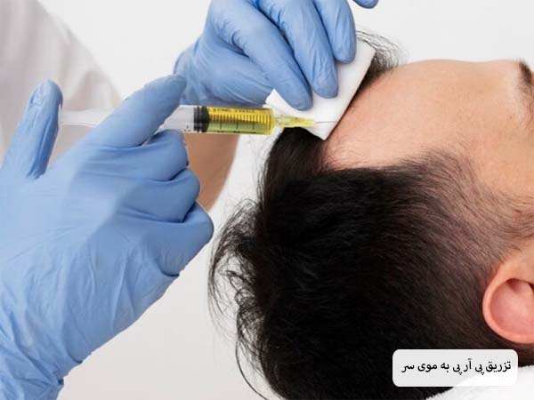 تزریق پی آر پی به موی سر یک آقا توسط متخصص.