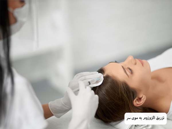 پزشک در حال تزریق اگزوزوم به موی سر یک خانم است.