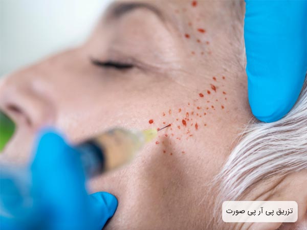 تزريق پي آر پي به صورت يک خانم که رد خون به شکل نقطه نقطه روي صورتش به جا گذاشته است.