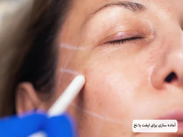 پزشک در حال رسم خطوطی روی صورت یک خانم است تا محل استفاده از نخ لیفت مشخص شود.