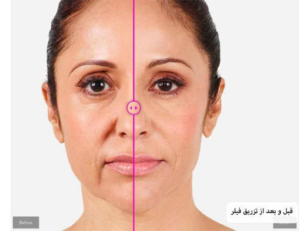 صورت یک خانم با خطوط خنده نسبتا عمیق قبل و بعد از تزریق فیلر در پس زمینه سفید.