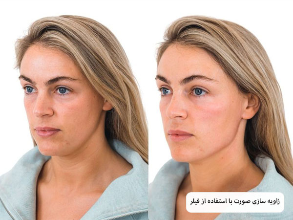 تزریق فیلر گونه به صورت یک خانم جوان تئوسط متخصص