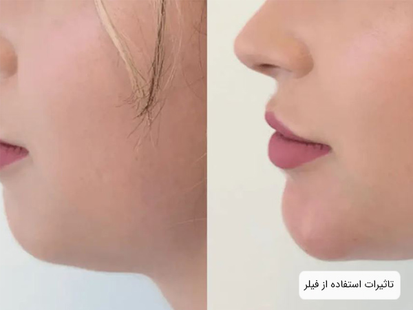تصوير از نيم رخ يک خانم قبل و بعد از استفاده از فيلر چانه.