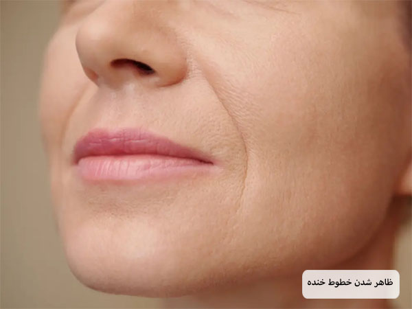 خطوط نازیولبال اطراف دهن یک خانم.