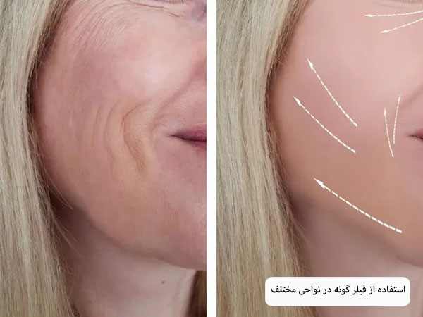 تزریق فیلر گونه به صورت یک خانم جوان تئوسط متخصص