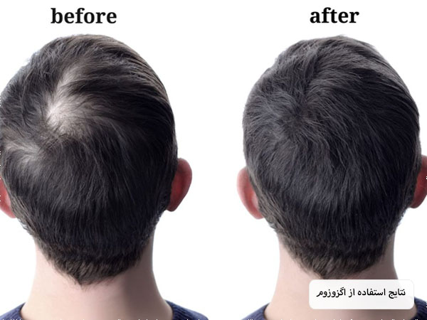 تزریق اگزوزوم توسط پزشک به موی سر یک آقا