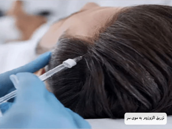 تزریق اگزوزوم توسط پزشک به موی سر یک آقا