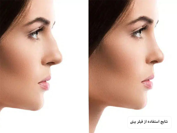 تصویری از نیم رخ یک خانم قبل و بعد از تزریق فیلر بینی که بینی یکنواخت و متناسب ایجاد نموده.