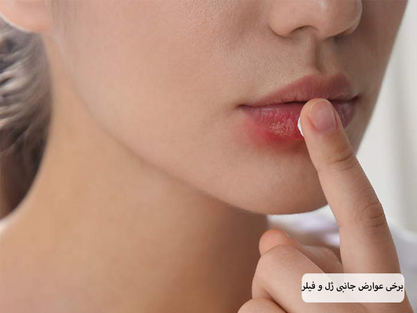 تاول روی لب یک خانم بعد از تزریق ژل یا فیلر لب.