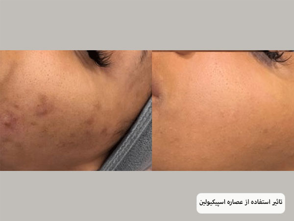 خانم جوانی که گیاه اسپیکیولین را روی صورت و گونه های خود مالیده است.