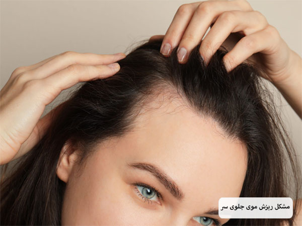 خانم جوانی که در حال بررسی ریزش مو های جلو سرش است.