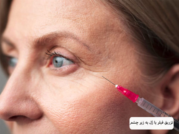 تزریق فیلر به زیر چشم یک خانم توسط پزشک.