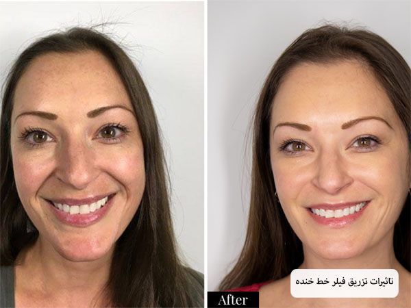 صورت یک خانم با خطوط خنده نسبتا عمیق قبل و بعد از تزریق فیلر در پس زمینه سفید.