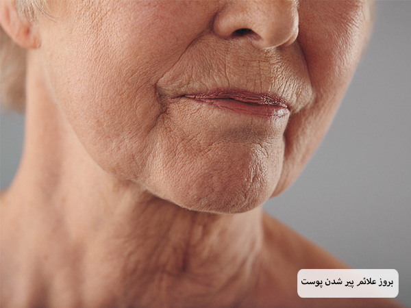 پوست صورت یک خانم که با بالا رفتن سن دچار چین و چروک شده است.