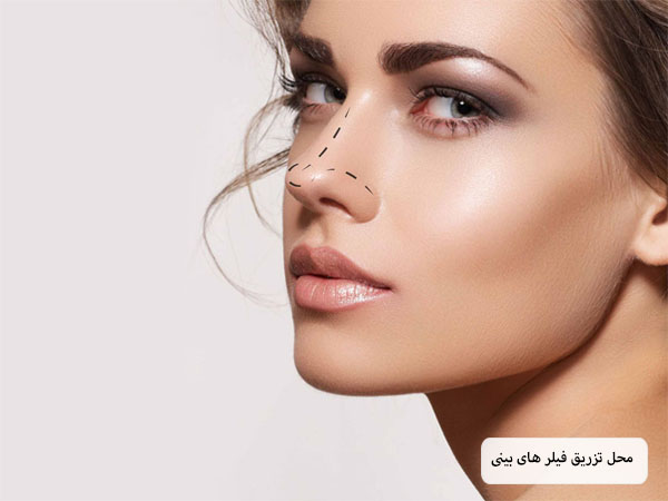 محل تزریق فیلر بینی که روی صورت یک خانم نمایش داده شده است.