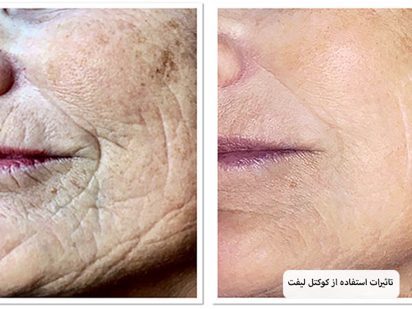 صورت یک خانم قبل و بعد از تزریق مزو لیفت که بهبود قابل توجهی یافته است.