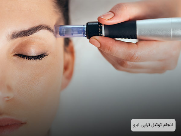 انجام کوکتل تراپي يا مزوتراپی روی ابرو های يک زيبا جوی جوان توسط مزوگان.