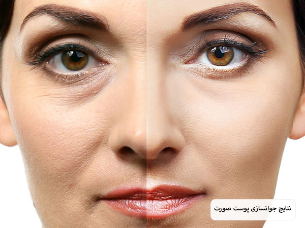 صورت یک خانم قبل و بعد از انجام پی آر پی و جوانسازی پوست در پس زمینه سفید.