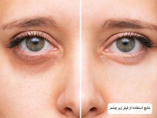 رفع تیرگی اطراف چشم یک خانم با استفاده از فیلر زیر چشم کره ای.