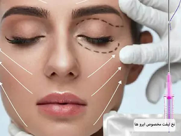 نقاط مختلف برای لیفت با نخ روی صورت یک خانم جوان نمایش داده شده است.