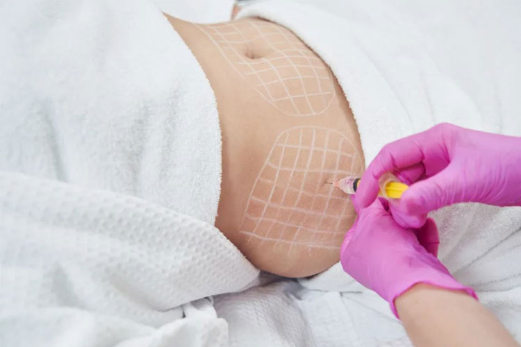 پزشک متخصص در حال تزريق مزو چربي سوز به شکم يک زيبا جو در کلينيک خود است.