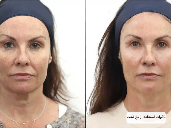 تصویر صورت یک خانم قبل و بعد از مصرف نخ لیفت صورت.