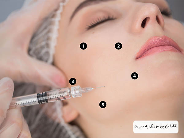 چند بسته مزوژل پروفایلو در پس زمینه در کنار هم.