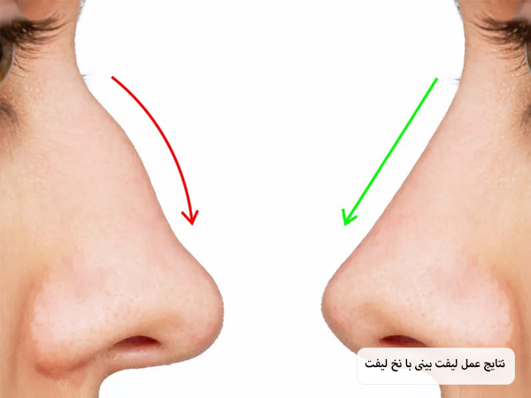 تصویر بینی یک خانم قبل و بعد از انجام لیفت با نخ که باعث شده قوز بینی برطرف شود در پس زمینه سفید.