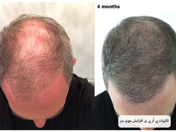 عکس سر یک آقا که چند ماه بعد از پی آر پی دچار رشد مو و رفع طاسی سر شده است.
