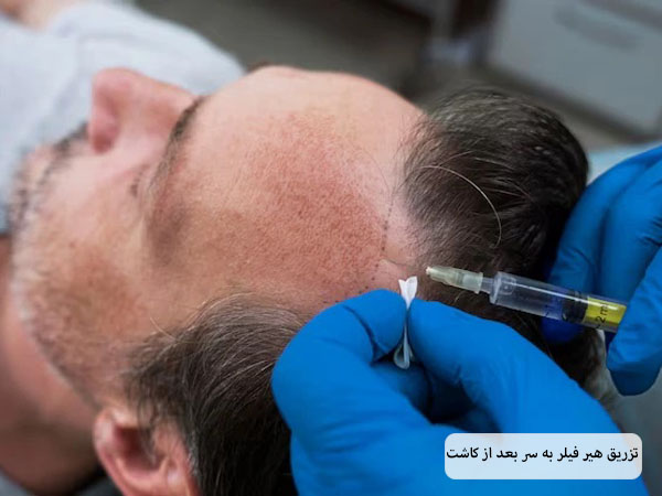 تزریق فیلر مو به سر یک آفا توسط متخصص
