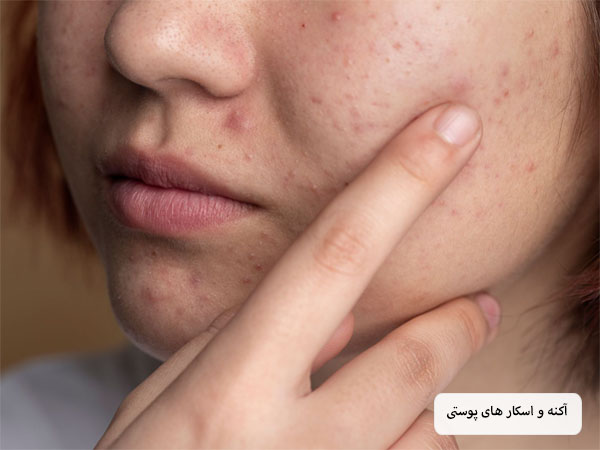 آسکار و آکنه های پوستی روی صورت یک خانم جوان.