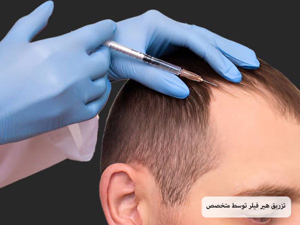 متخصص در حال تزریق محلول هیرفیلر به موی سر یک آقای جوان است.