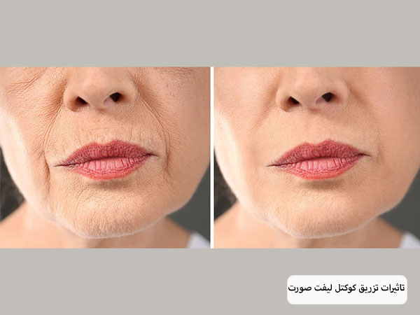 صورت یک خانم قبل و بعد از تزریق کوکتل مزوتراپی لیفت صورت که بهبود چشم گیری داشته است.