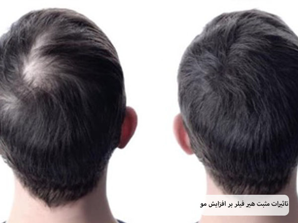 مو های سر یک آقا که با تزریق هیرفیلر بسیار پرپشت تر شده اند در پس زمینه سفید.