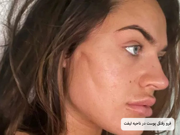 صورت یک خانم که دچار فرورفتگی در ناحیه لیفت شده است.