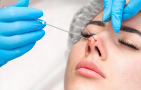 لیفت بینی زیبا جوی خانم با نخ لیفت مخصوص توسط پزشک متخصص.