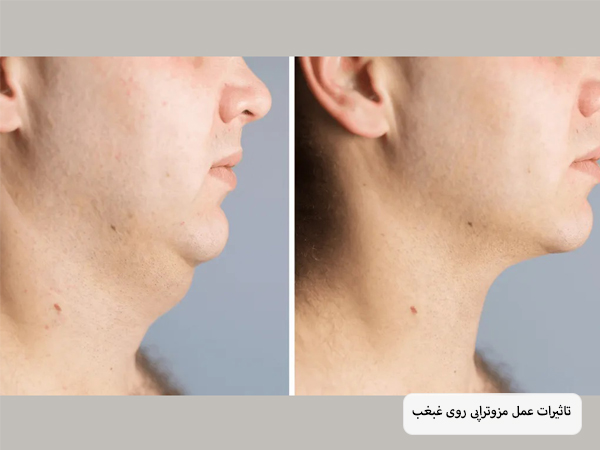 غبغب شخصی قبل و بعد از انجام عمل مزوتراپی که به طور قابل توجهی کوچک تر شده است.