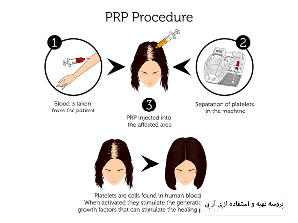 پروسه تهیه و انجام پی آر پی که به صورت مصور در یک پس زمینه سفید به نمایش در آمده است.