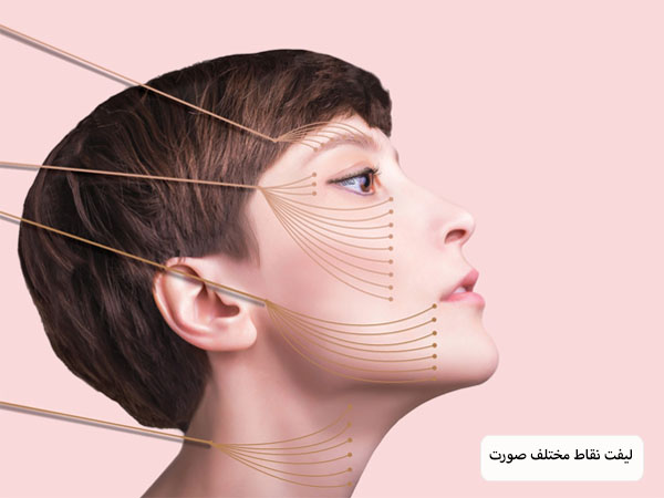 قسمت های مختلف صورت یک خانم جوان که با نخ لیفت برای جوانسازی نشانه گذاری شده است از نمای نیم رخ در پس زمینه یاسی رنگ.